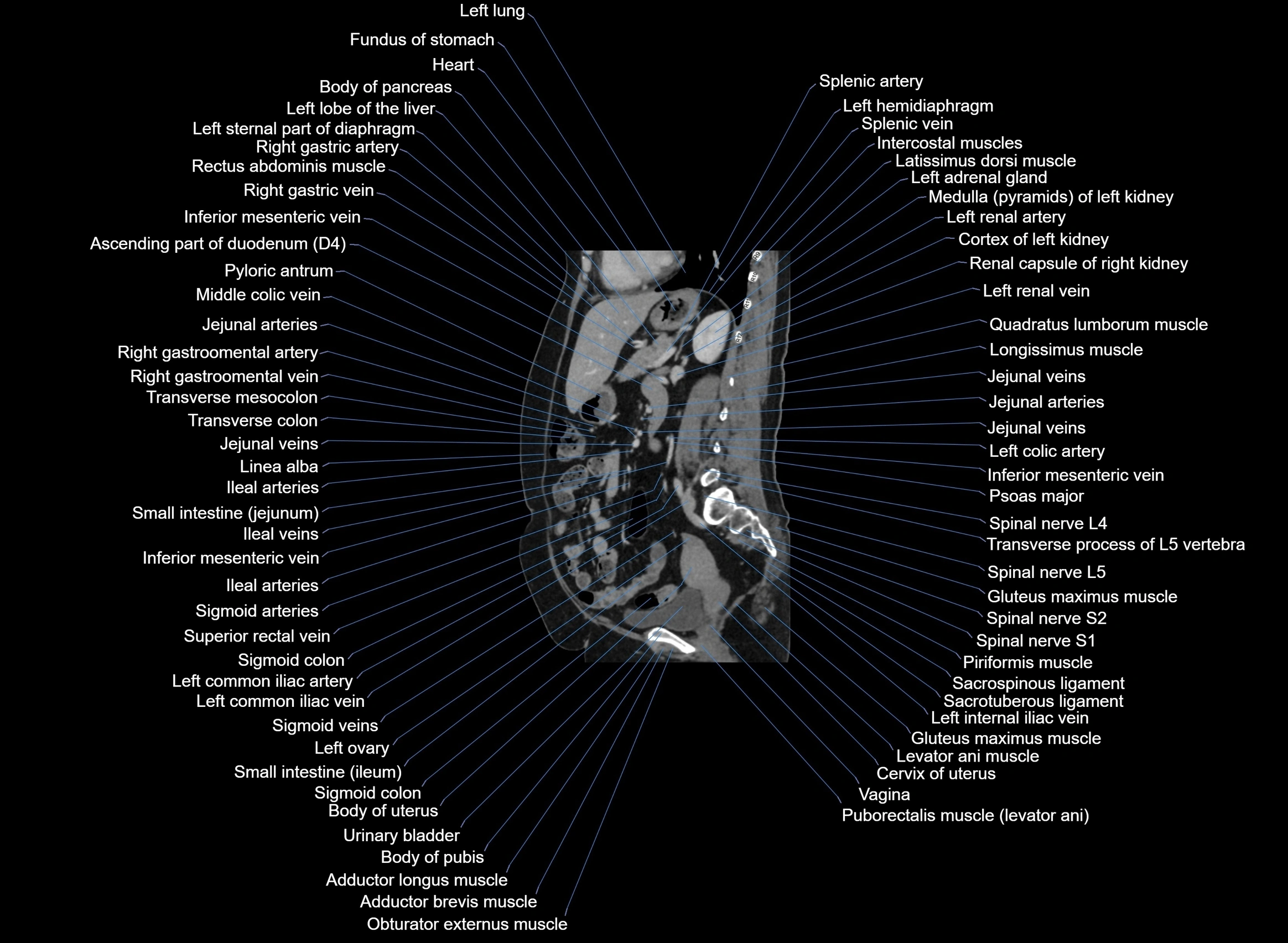 CT Abdomen sagittal cross sectional anatomy labelled radiology image -00050.webp